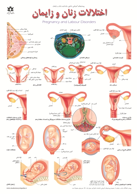 پوستر اختلالات بارداری و بیماری زنان و زایمان